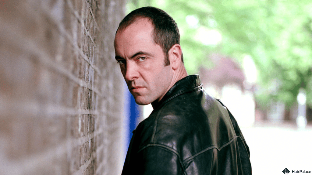 James Nesbittbefore hair transplant